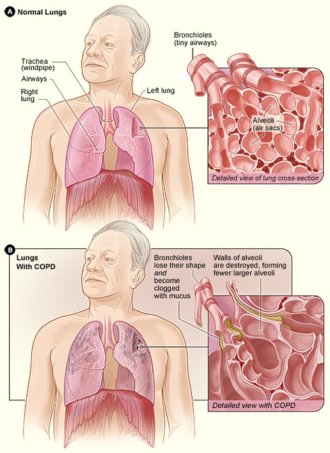  Chronic obstructive pulmonary disease 