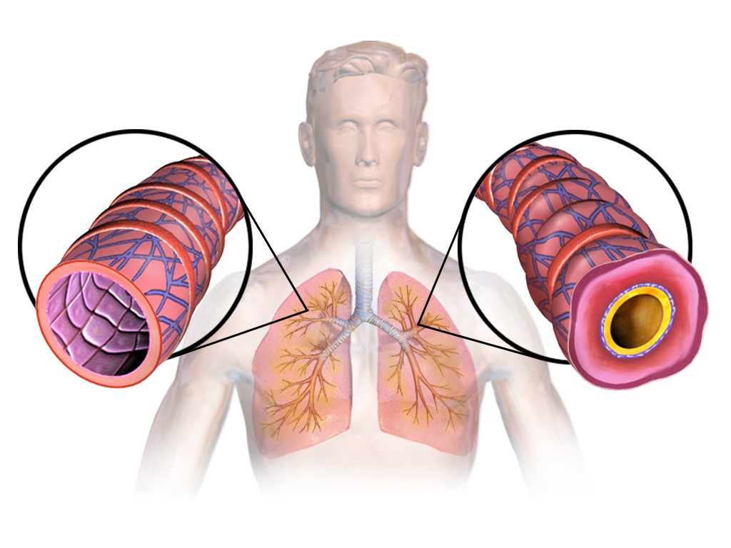 Asthmatic lungs