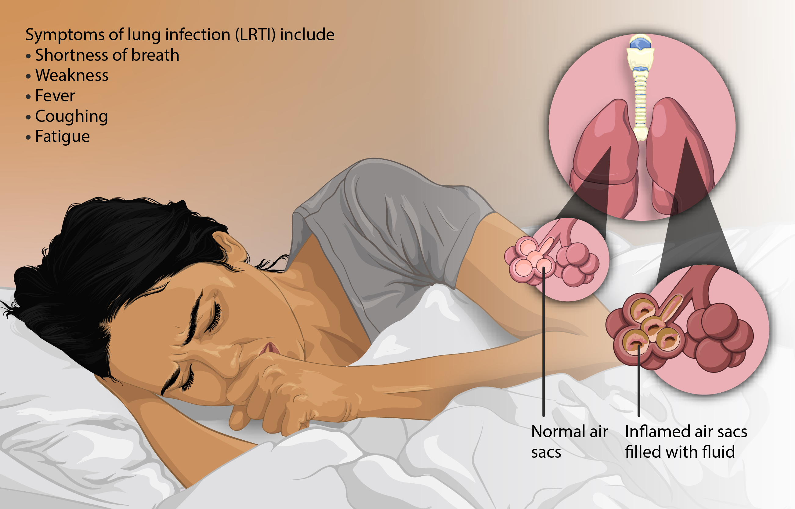 Respiratory Infections