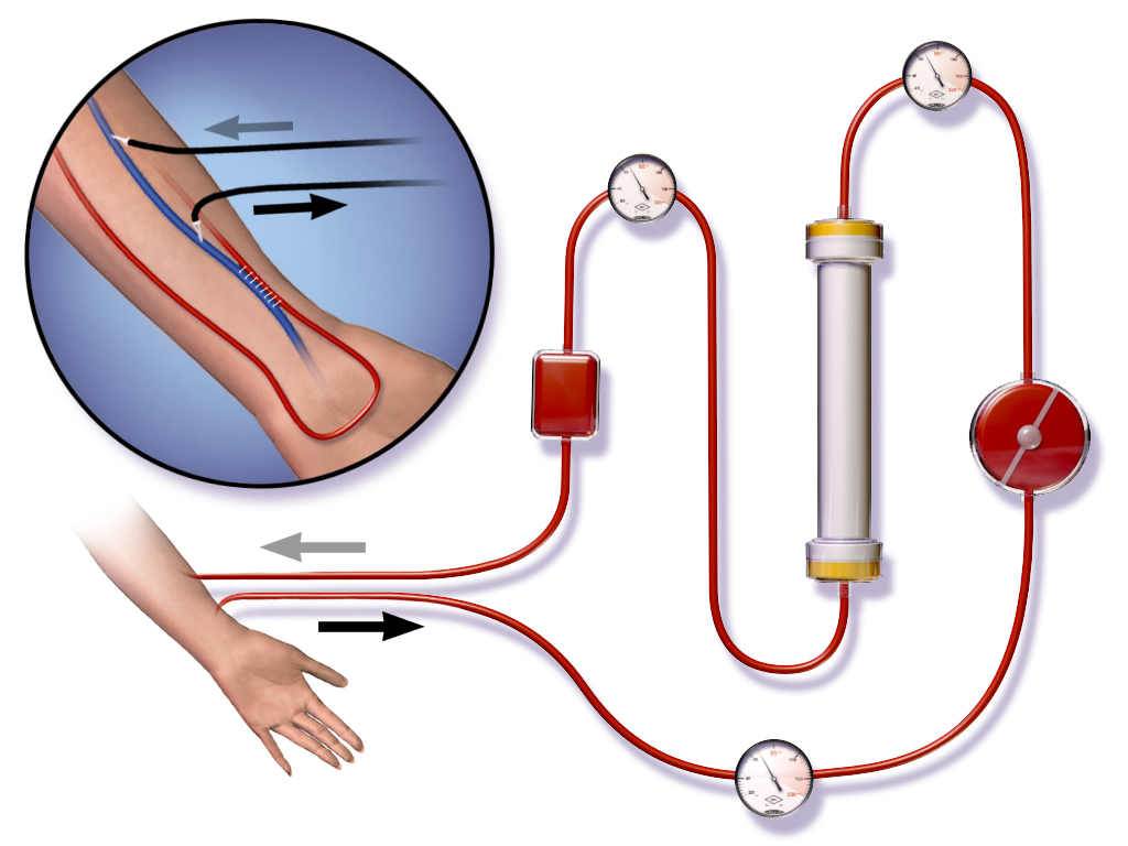 Dialysis