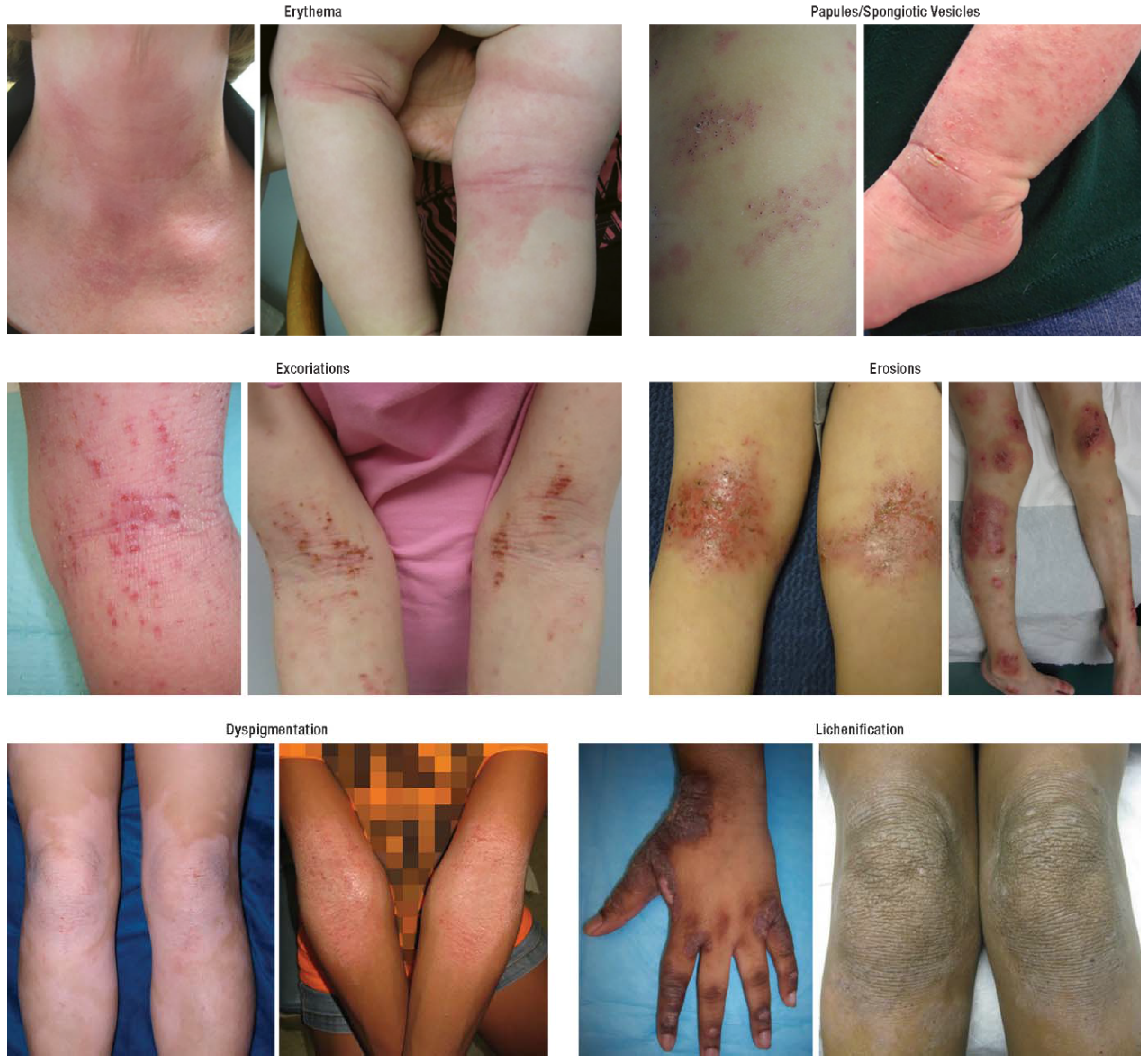 Atopic dermatitis