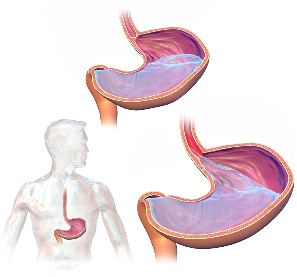  gastroesophageal reflux disease 