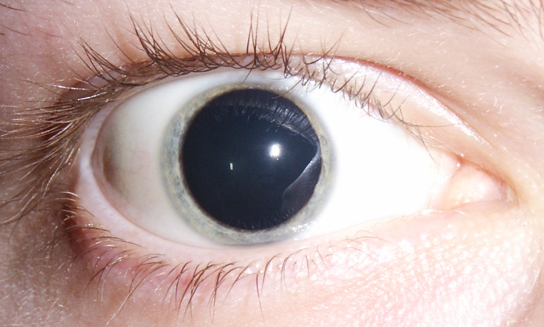 Eyes with Enlarged Pupils