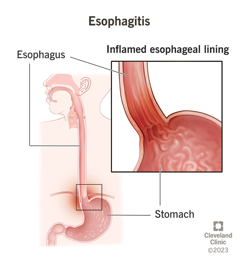 erosive-esophagitis