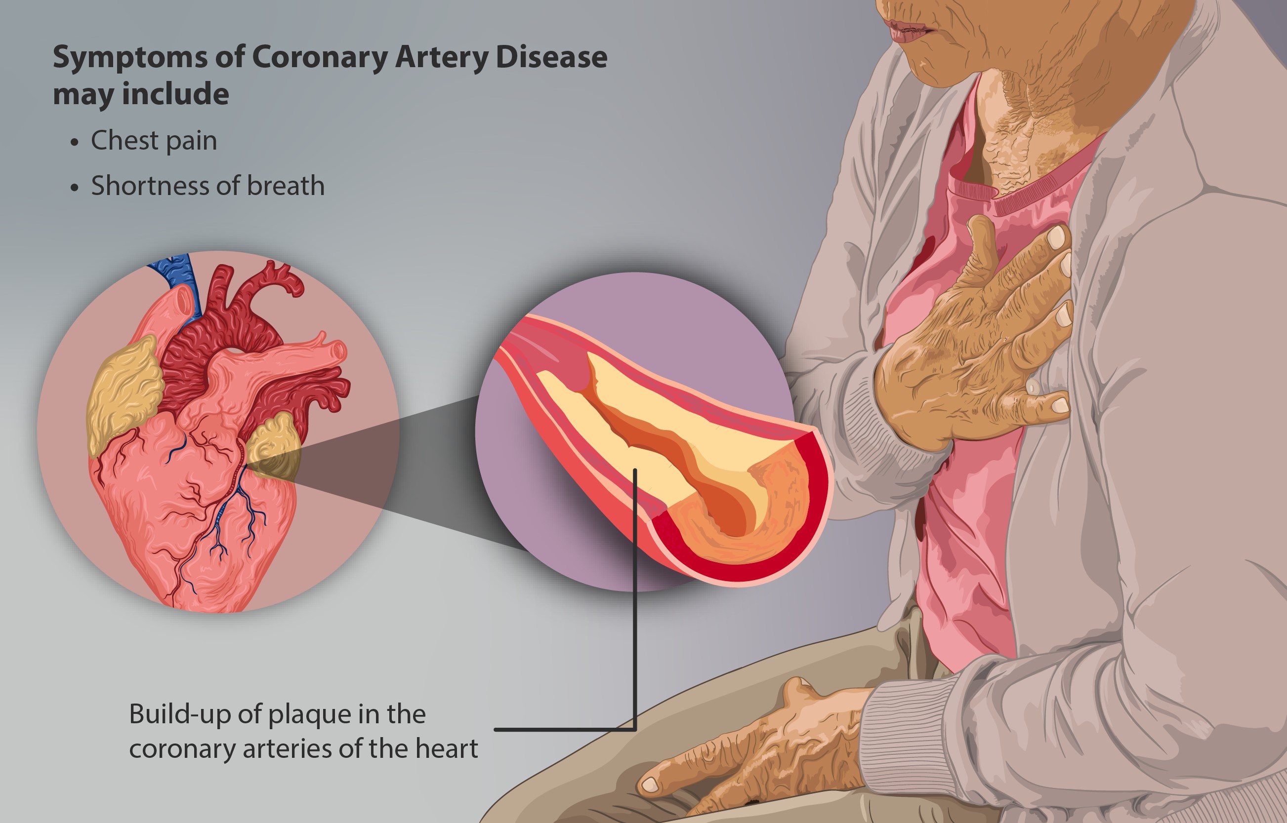 Coronary artery disease